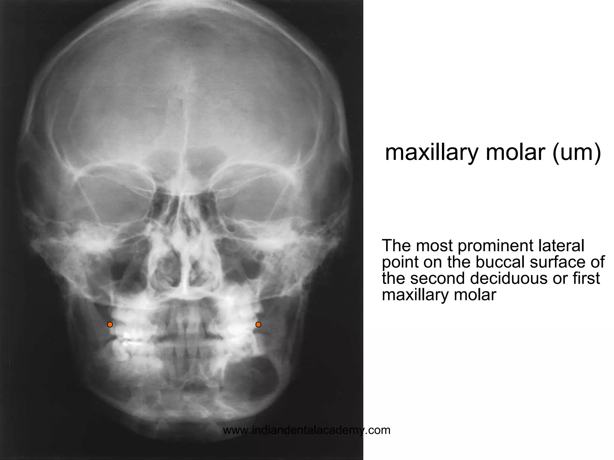 The most prominent lateral
point on the buccal surface of
the second deciduous or first
maxillary molar
maxillary molar (um)
www.indiandentalacademy.com
 