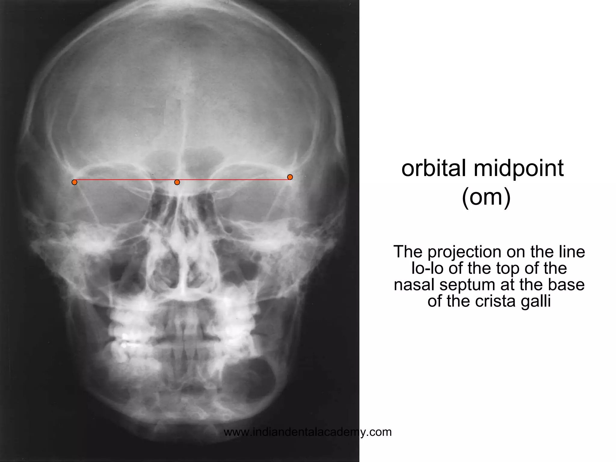 The projection on the line
lo-lo of the top of the
nasal septum at the base
of the crista galli
orbital midpoint
(om)
www.indiandentalacademy.com
 