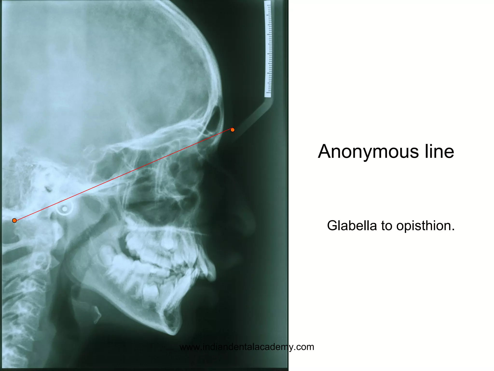 Glabella to opisthion.
Anonymous line
www.indiandentalacademy.com
 