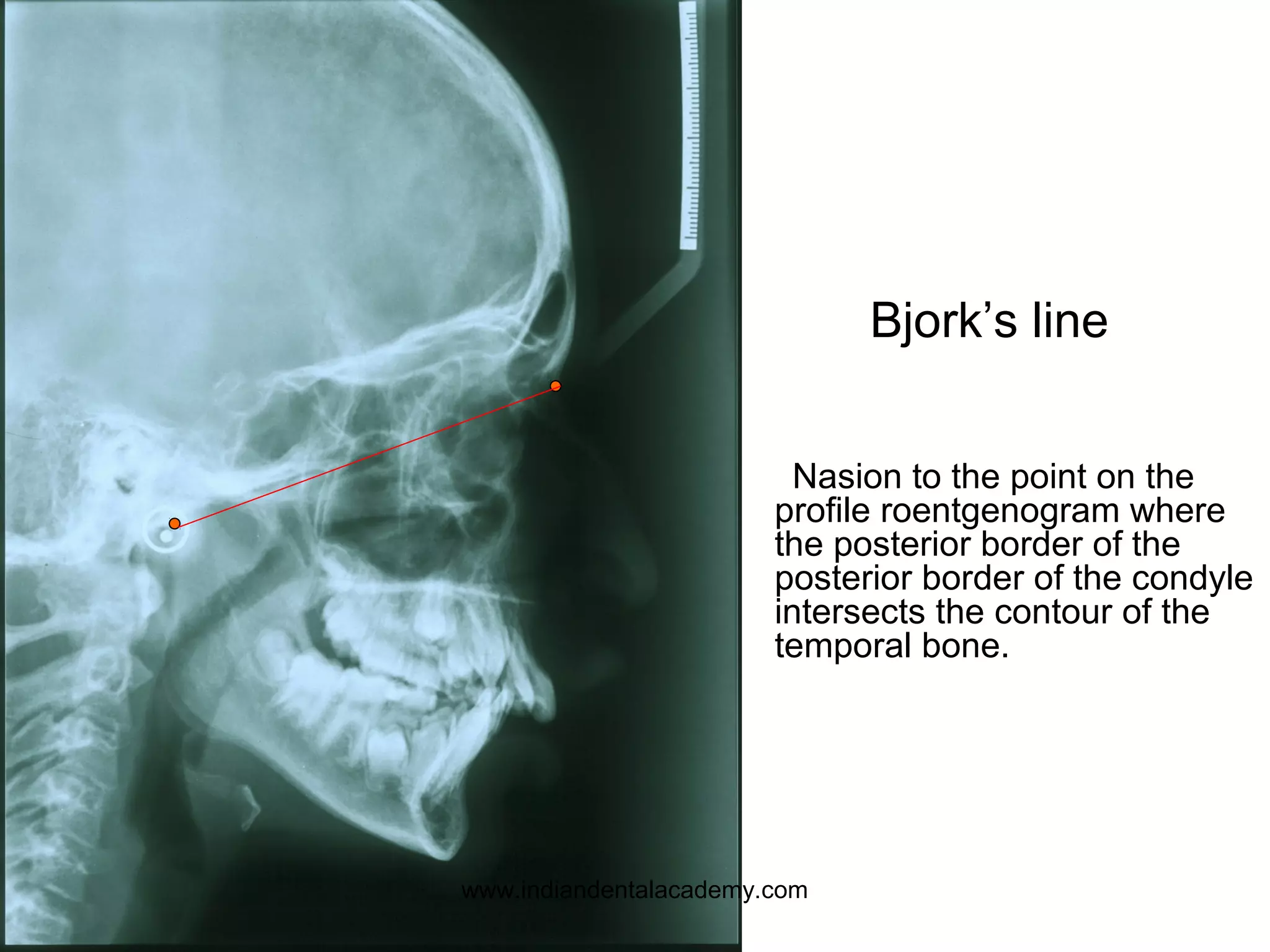 Bjork’s line
Nasion to the point on the
profile roentgenogram where
the posterior border of the
posterior border of the condyle
intersects the contour of the
temporal bone.
www.indiandentalacademy.com
 