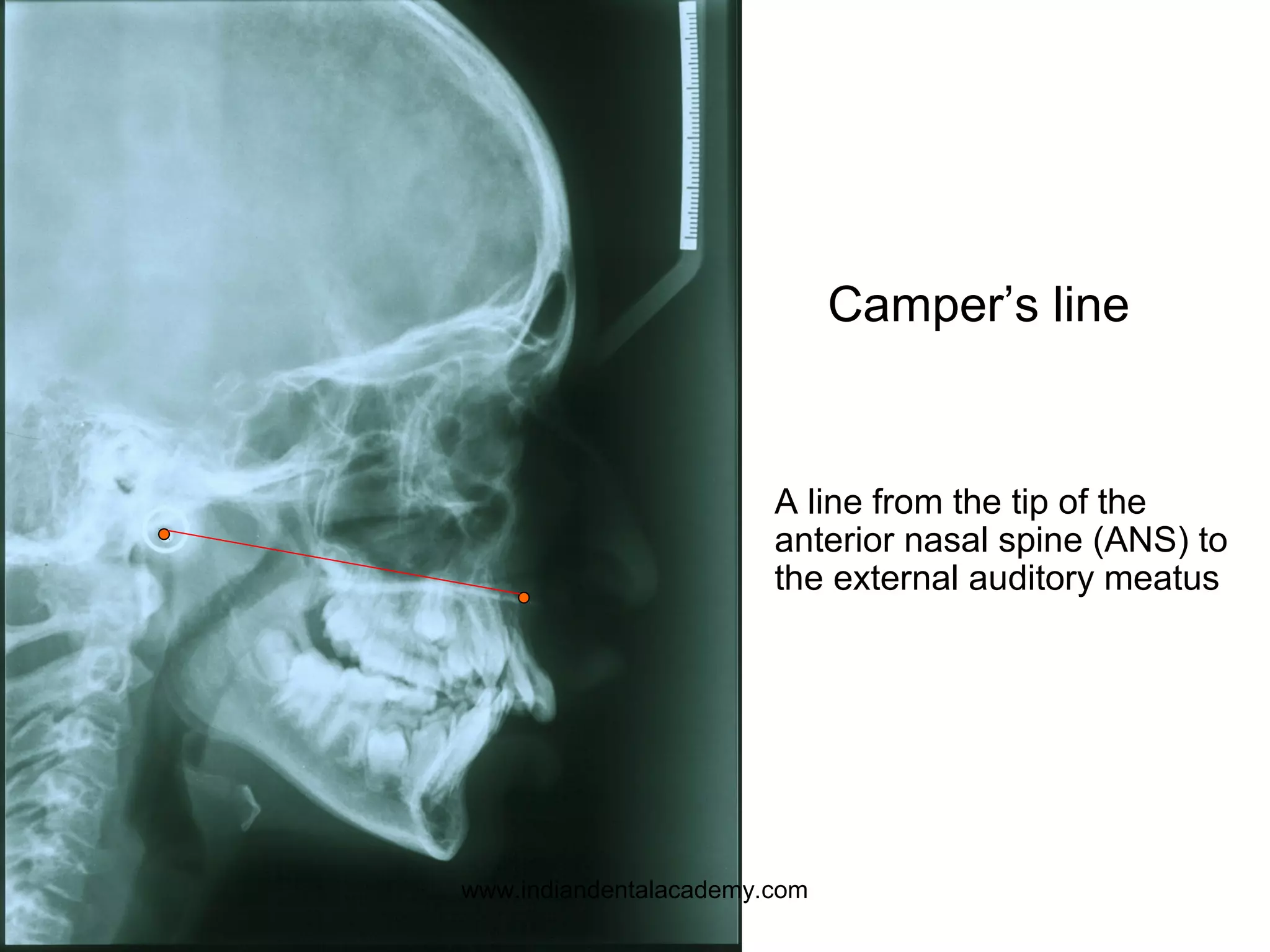 Camper’s line
A line from the tip of the
anterior nasal spine (ANS) to
the external auditory meatus
www.indiandentalacademy.com
 