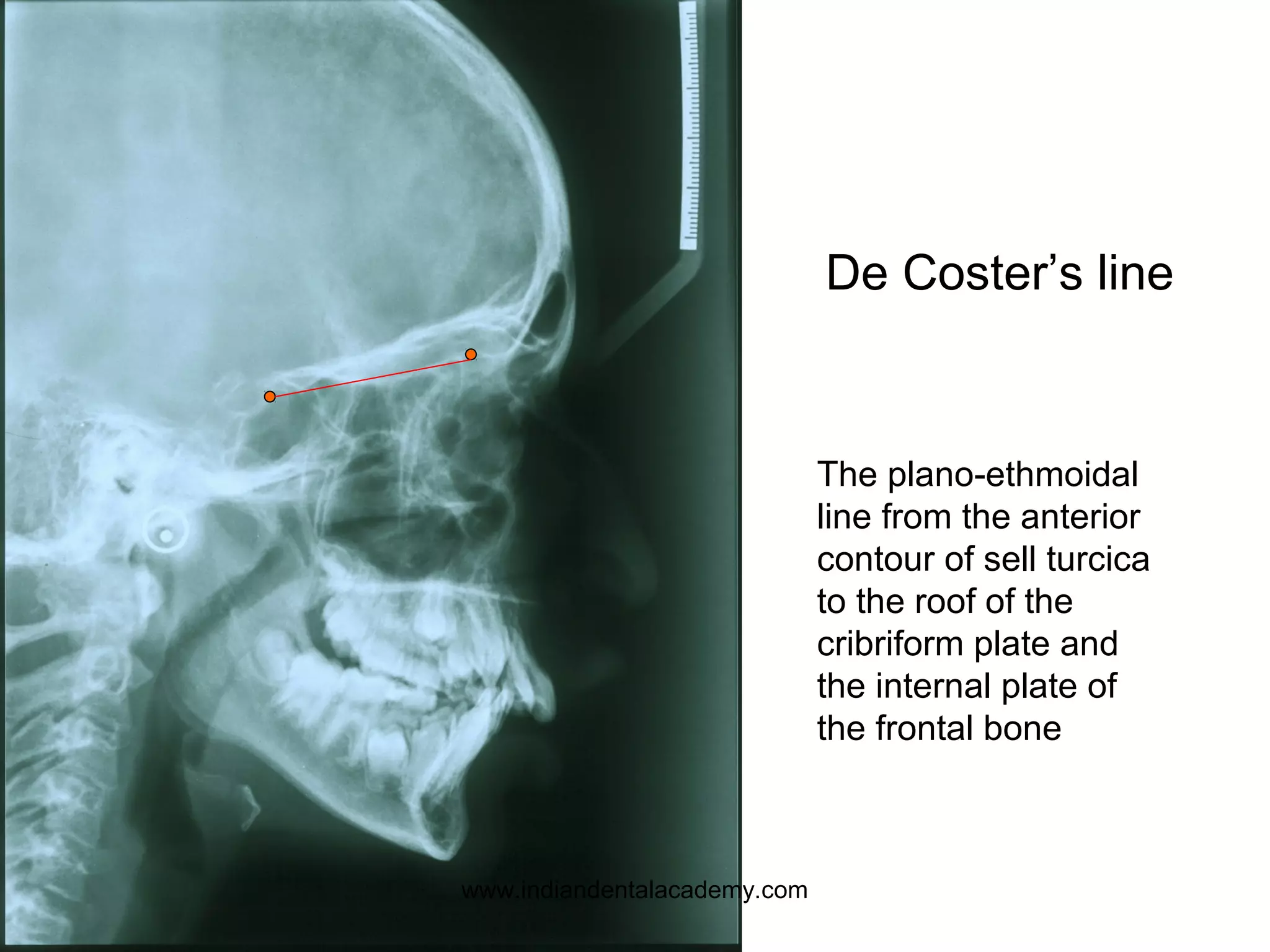 De Coster’s line
The plano-ethmoidal
line from the anterior
contour of sell turcica
to the roof of the
cribriform plate and
the internal plate of
the frontal bone
www.indiandentalacademy.com
 