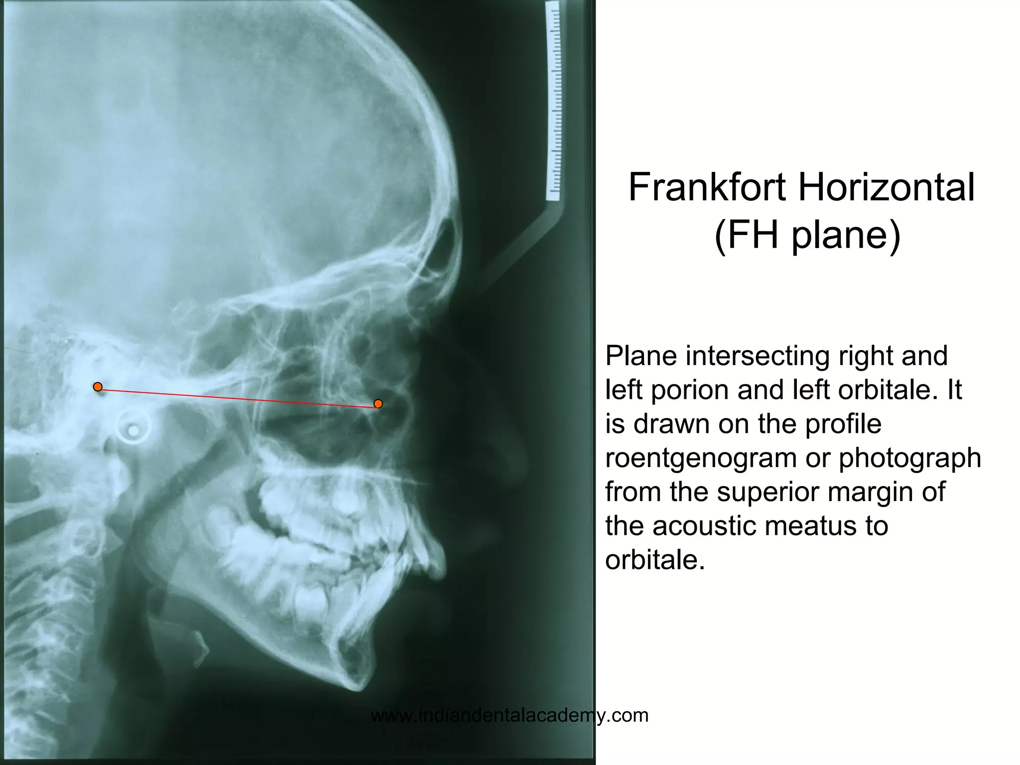 Frankfort Horizontal
(FH plane)
Plane intersecting right and
left porion and left orbitale. It
is drawn on the profile
roentgenogram or photograph
from the superior margin of
the acoustic meatus to
orbitale.
www.indiandentalacademy.com
 