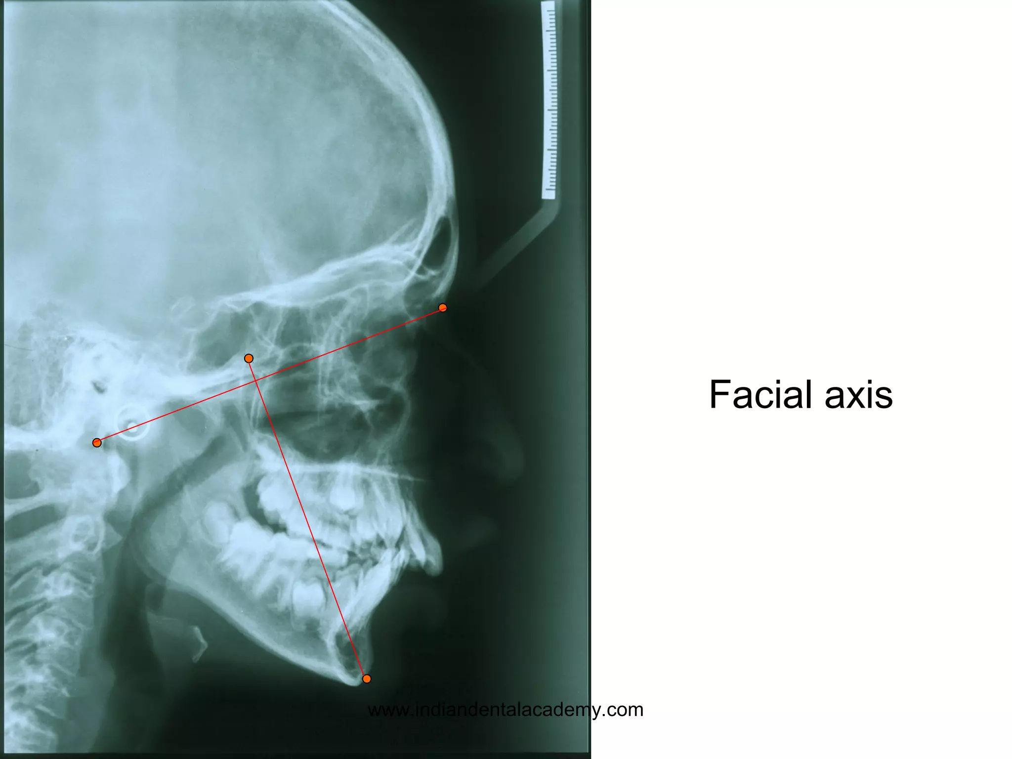 Facial axis
www.indiandentalacademy.com
 