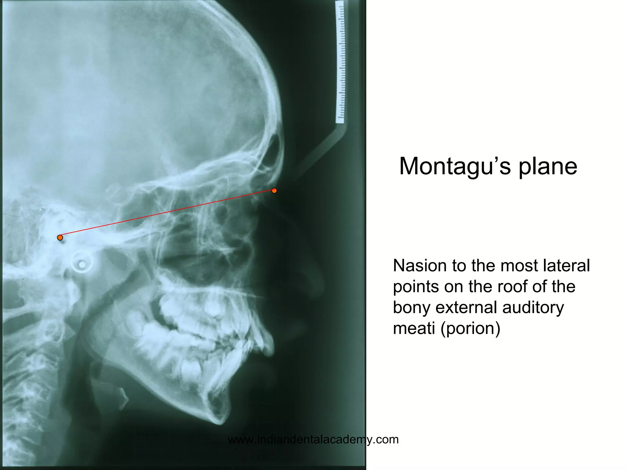 Montagu’s plane
Nasion to the most lateral
points on the roof of the
bony external auditory
meati (porion)
www.indiandentalacademy.com
 