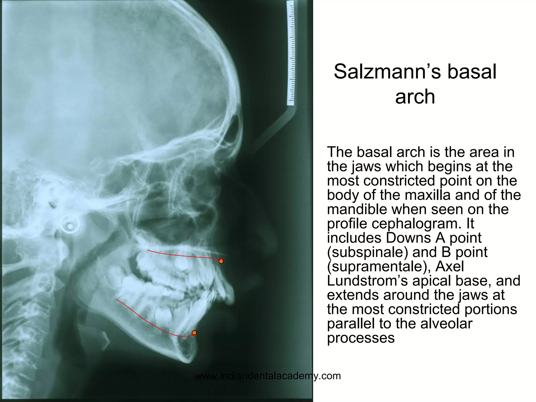 Salzmann’s basal
arch
The basal arch is the area in
the jaws which begins at the
most constricted point on the
body of the maxilla and of the
mandible when seen on the
profile cephalogram. It
includes Downs A point
(subspinale) and B point
(supramentale), Axel
Lundstrom’s apical base, and
extends around the jaws at
the most constricted portions
parallel to the alveolar
processes
www.indiandentalacademy.com
 