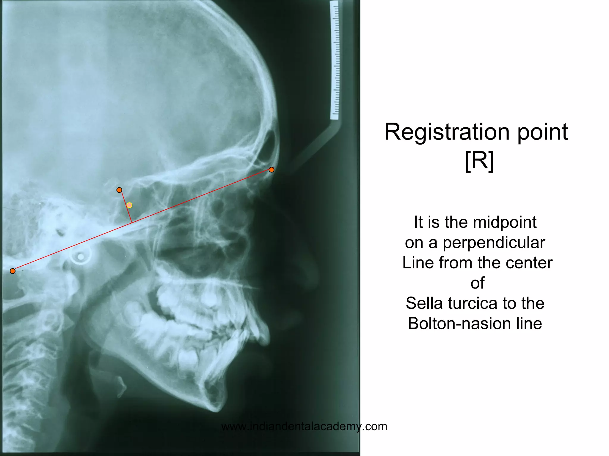 Registration point
[R]
It is the midpoint
on a perpendicular
Line from the center
of
Sella turcica to the
Bolton-nasion line
www.indiandentalacademy.com
 