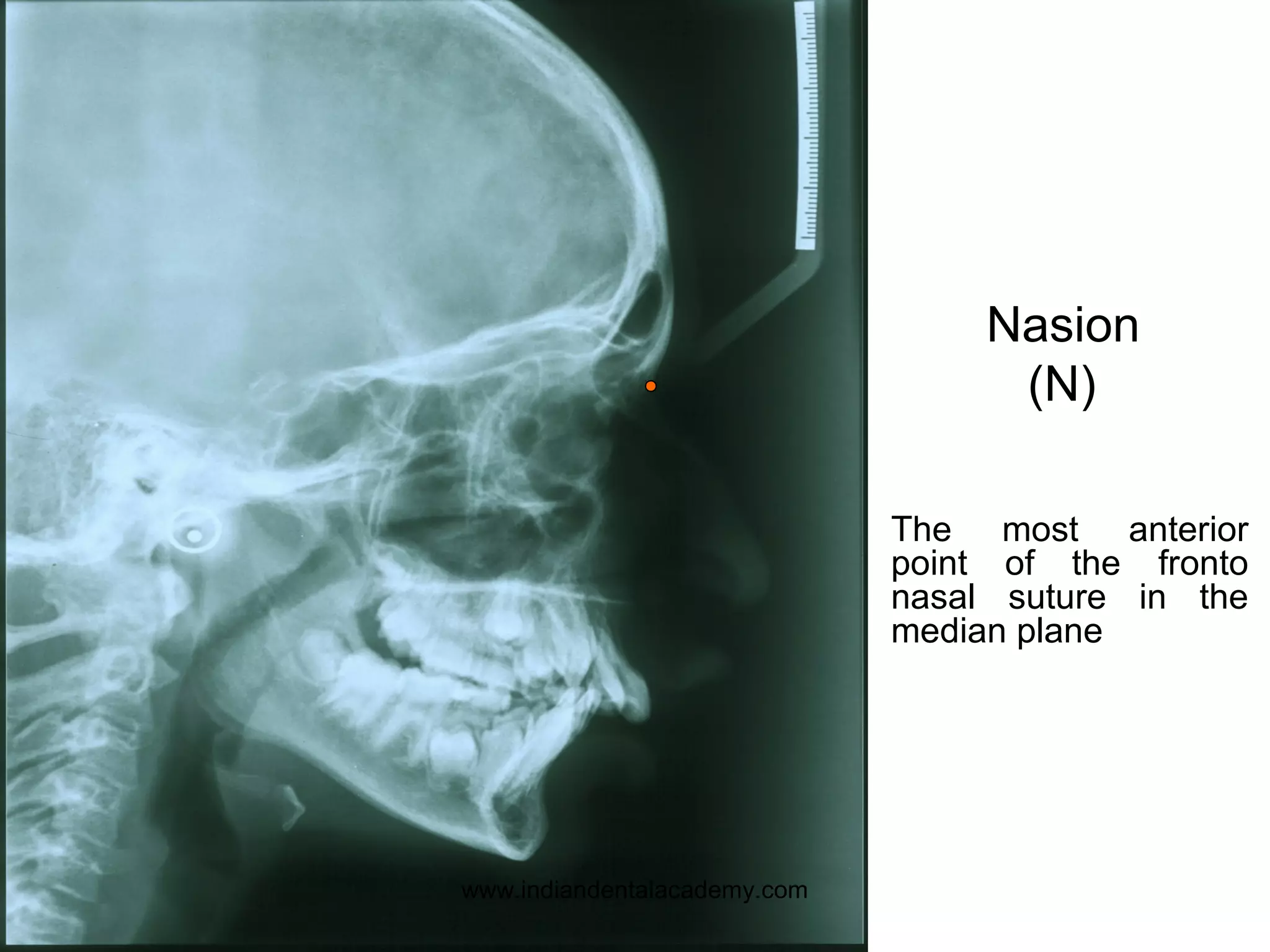 The most anterior
point of the fronto
nasal suture in the
median plane
Nasion
(N)
www.indiandentalacademy.com
 