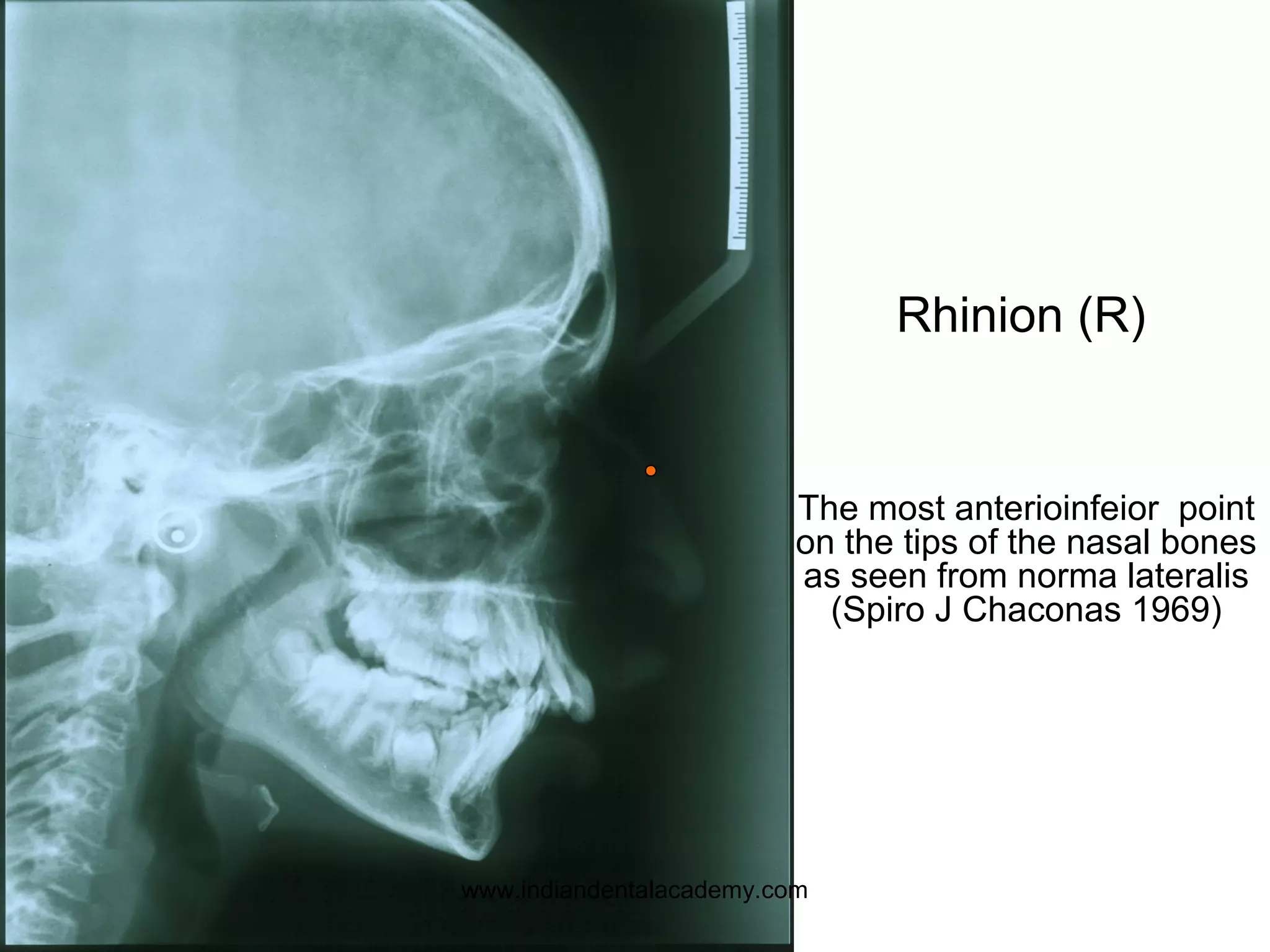 Rhinion (R)
The most anterioinfeior point
on the tips of the nasal bones
as seen from norma lateralis
(Spiro J Chaconas 1969)
www.indiandentalacademy.com
 