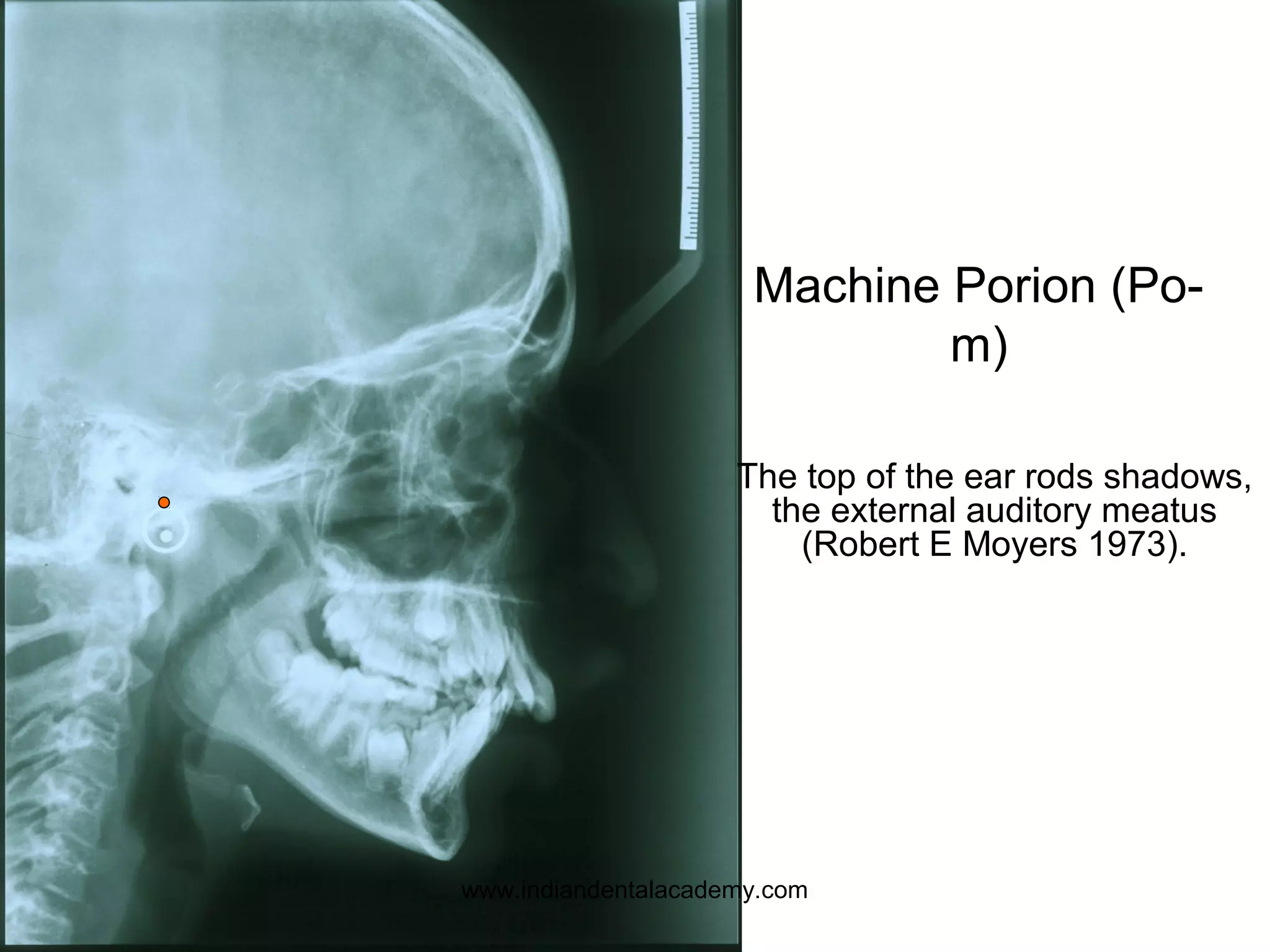 Machine Porion (Po-
m)
The top of the ear rods shadows,
the external auditory meatus
(Robert E Moyers 1973).
www.indiandentalacademy.com
 