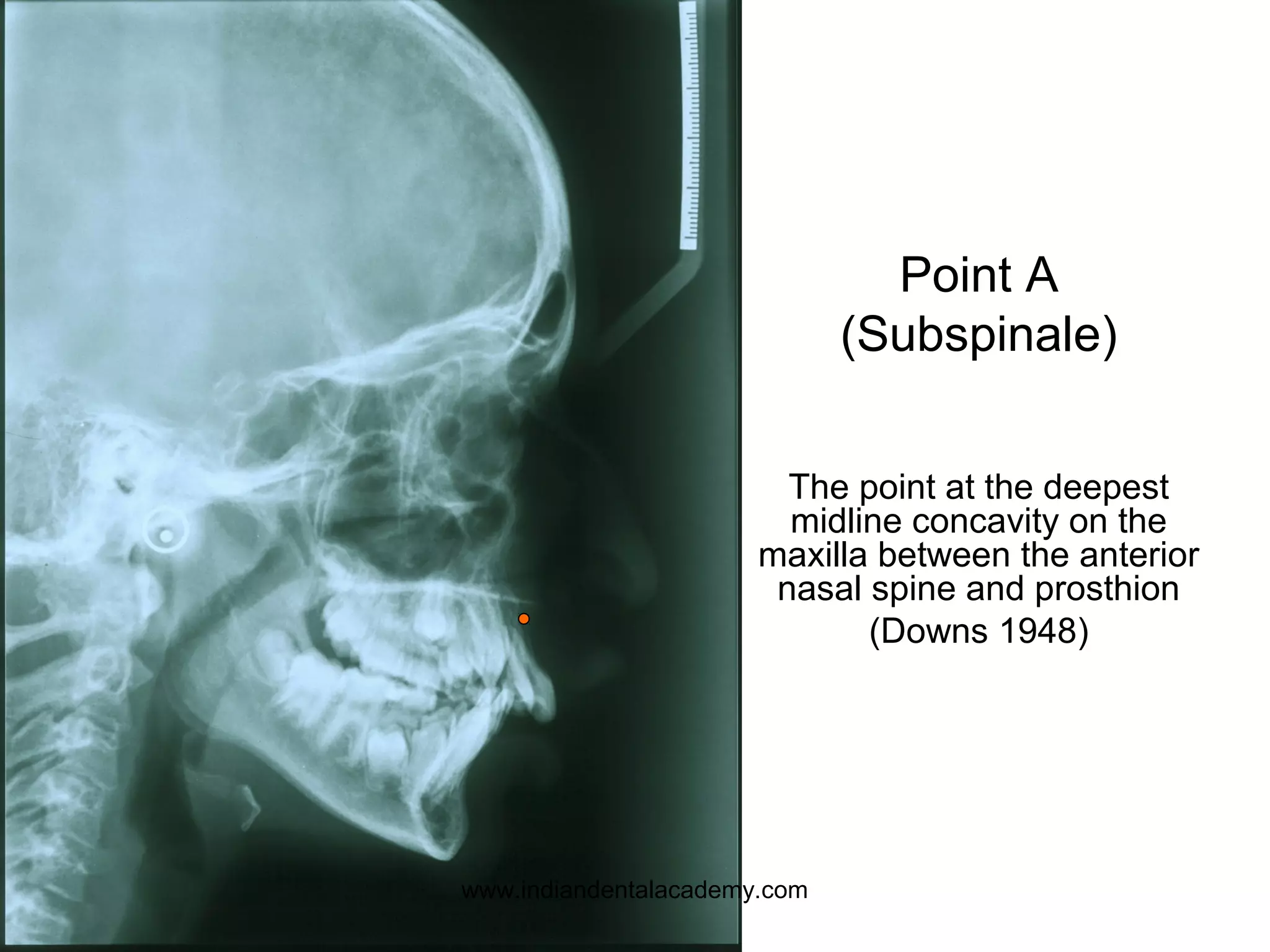 Point A
(Subspinale)
The point at the deepest
midline concavity on the
maxilla between the anterior
nasal spine and prosthion
(Downs 1948)
www.indiandentalacademy.com
 