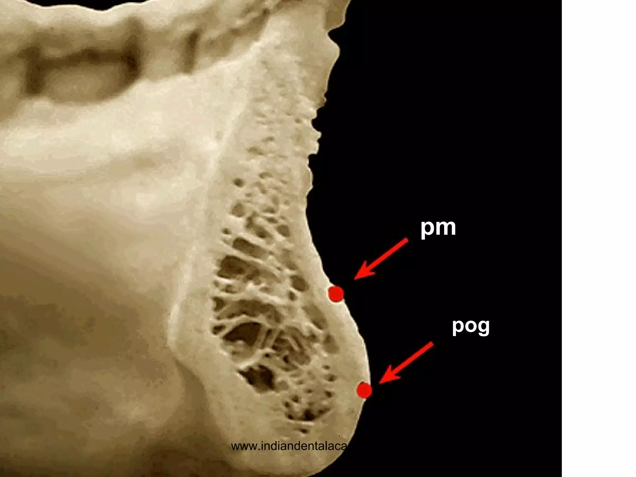 pm
pog
www.indiandentalacademy.com
 