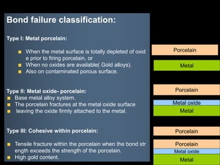 Bond failure classification:
Type I: Metal porcelain:
When the metal surface is totally depleted of oxid
e prior to firing porcelain, or
When no oxides are available( Gold alloys).
Also on contaminated porous surface.
Type II: Metal oxide- porcelain:
Base metal alloy system.
The porcelain fractures at the metal oxide surface
leaving the oxide firmly attached to the metal.
Type III: Cohesive within porcelain:
Tensile fracture within the porcelain when the bond str
ength exceeds the strength of the porcelain.
High gold content.
Metal
Porcelain
Metal
Porcelain
Metal oxide
Metal
Porcelain
Porcelain
Metal oxide
 