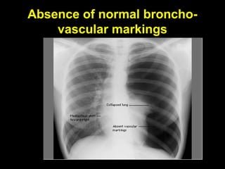 Bronkovascular Pattern Basic chest x ray interpretation | PPT