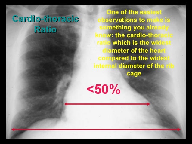Basic chest x ray interpretation