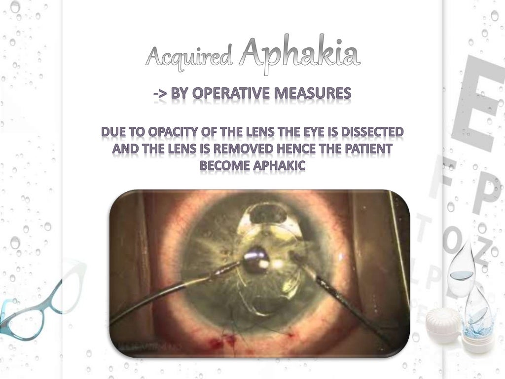 Aphakia