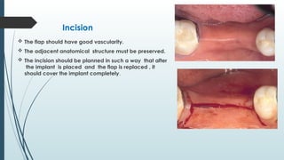 Basic concept of dental implantology.pptx