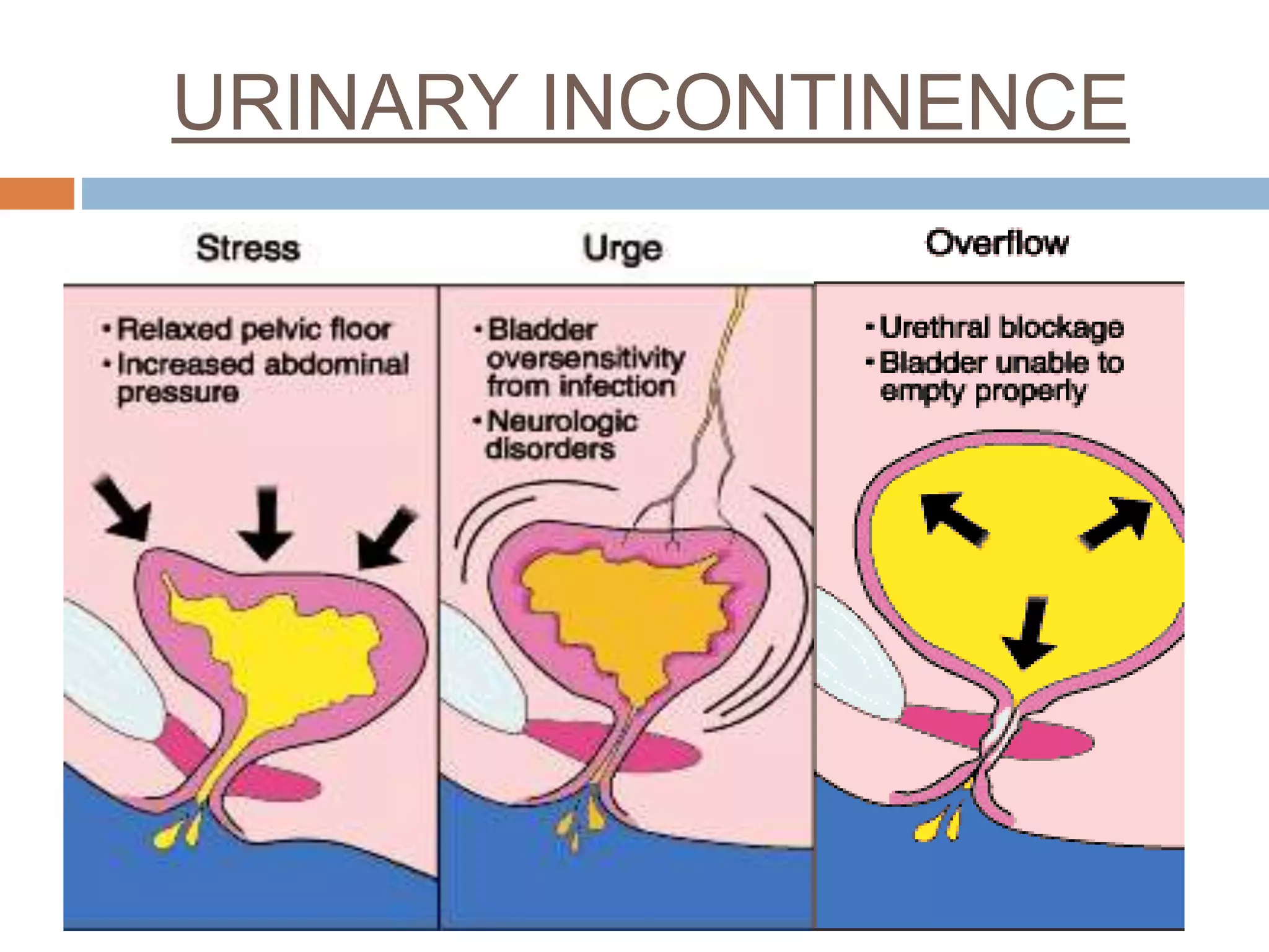 URINARY INCONTINENCE
 