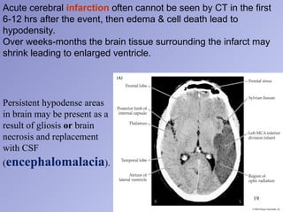 Basic concepts of computed tomography scan of the brain 2.ppt