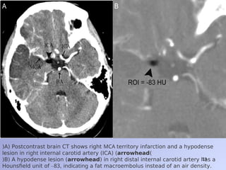 Ica Infarct Basic concepts of computed tomography scan of the brain 2.ppt