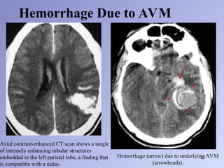 Basic concepts of computed tomography scan of the brain 2.ppt