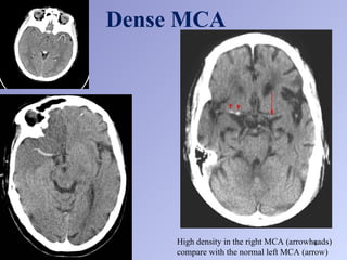 Mca Graph Normal Basic concepts of computed tomography scan of the brain 2.ppt