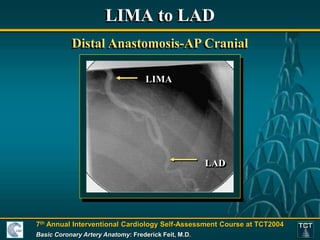Lima Dissection Basic Coronary Anatomy - Paul Fefer, MD..ppt