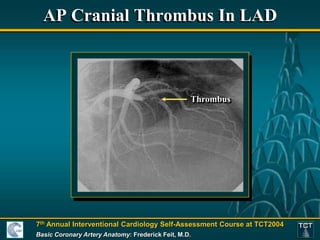 Basic Coronary Anatomy - Paul Fefer, MD..ppt