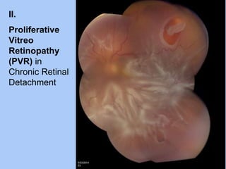 Pvr Optometry Pathology of Retina and Vitreous | PPTX