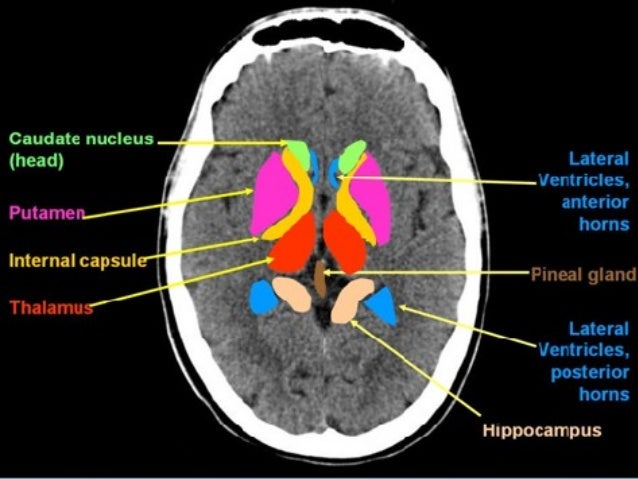 Basic ct brain and rapid CT interpretation