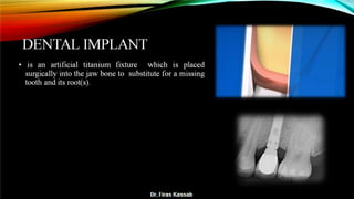 Basic dental implant
