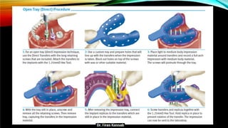 Basic dental implant