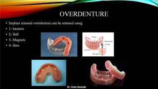 Basic dental implant