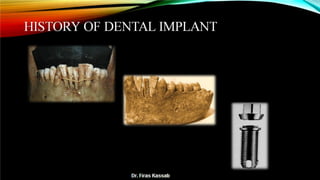Basic dental implant