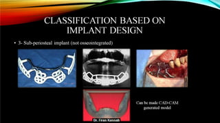 Basic dental implant