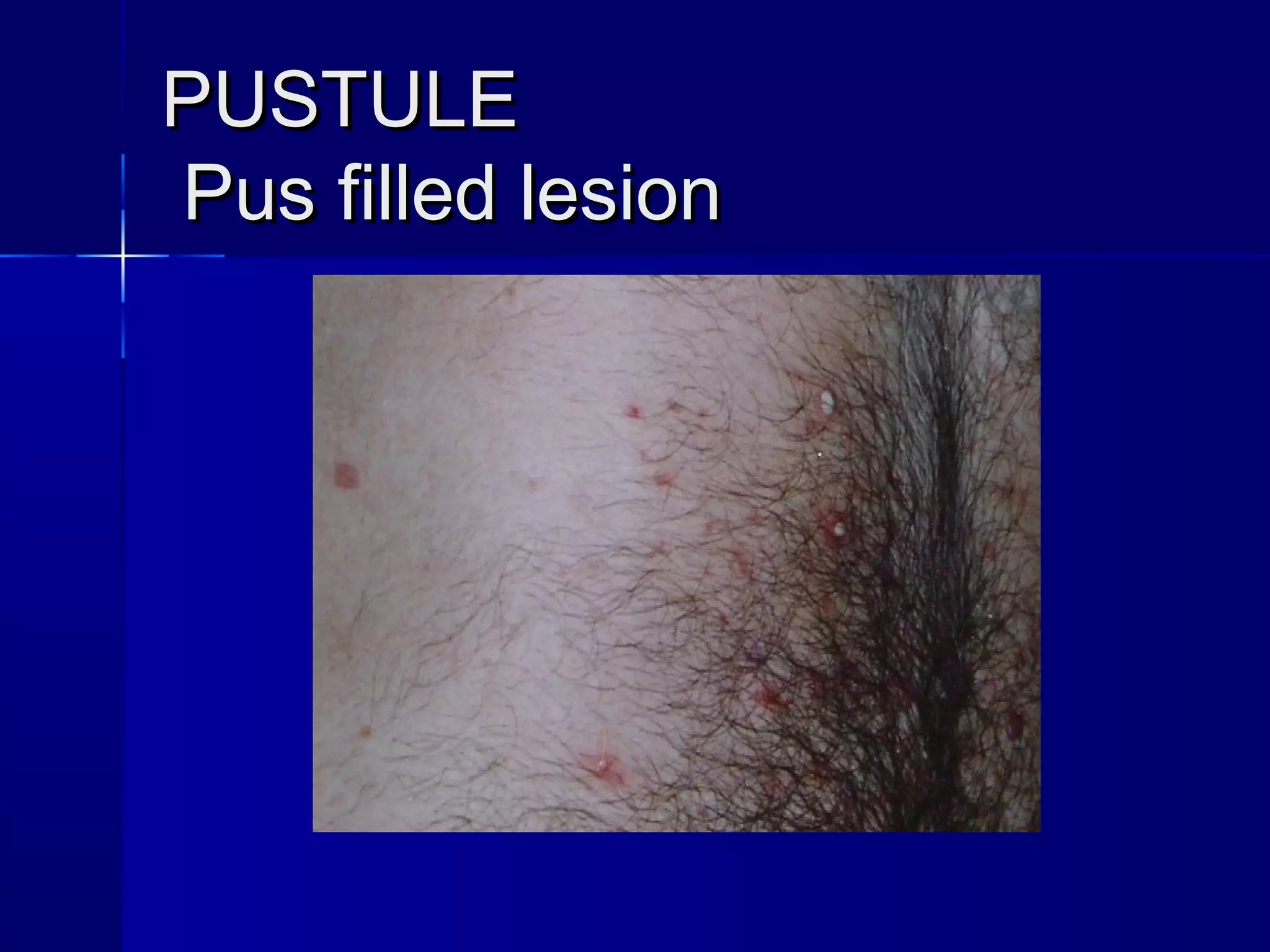 Pinpoint Pustule Basic dermatology by Dr. Haseeb Ahmed | PPT