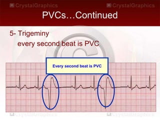 PVCs…Continued
5- Trigeminy
every second beat is PVC
Every second beat is PVC
 