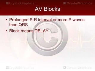 AV Blocks
• Prolonged P-R interval or more P waves
than QRS
• Block means DELAY.
 