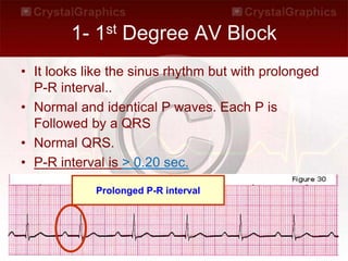 1- 1st Degree AV Block
• It looks like the sinus rhythm but with prolonged
P-R interval..
• Normal and identical P waves. Each P is
Followed by a QRS
• Normal QRS.
• P-R interval is > 0.20 sec.
Prolonged P-R interval
 