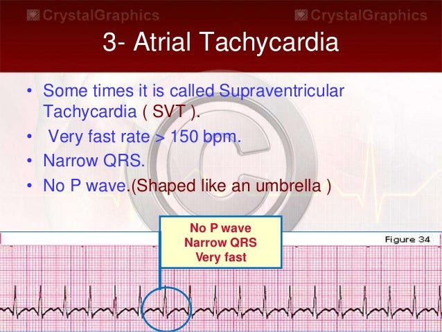 Basic dysrhythmia interpretation Basic dysrhythmia interpretation