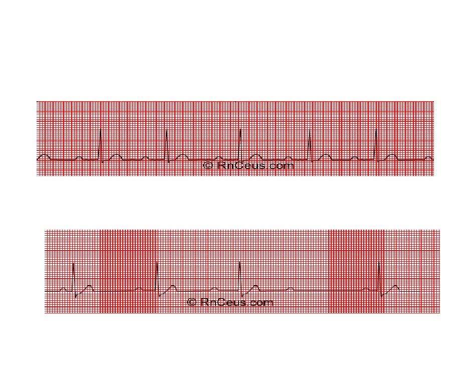 Basic Ecg