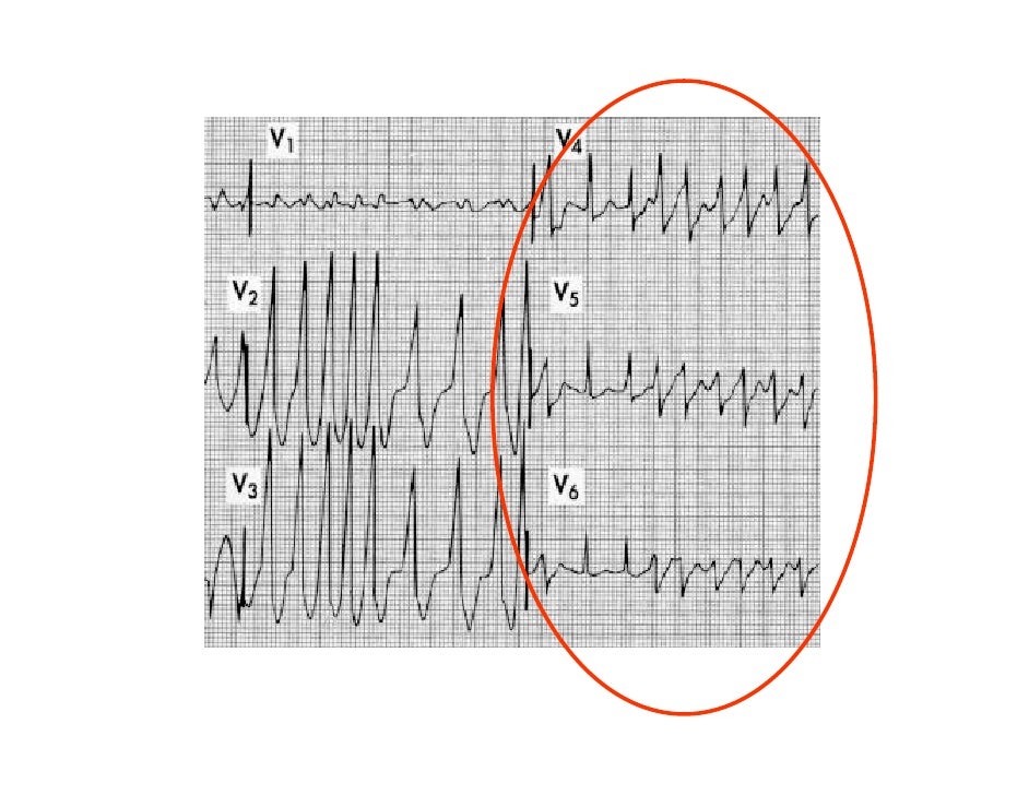 Basic Ecg