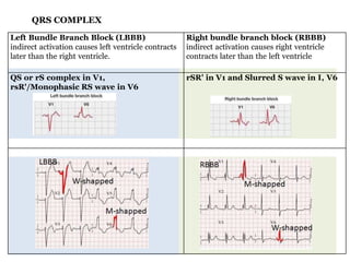 Rsr Rbbbb Basic ecg | PPTX