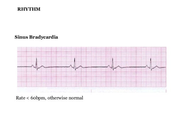 Basic Ecg