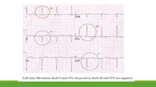 Basic ecg | PPTX