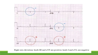Basic ecg | PPTX