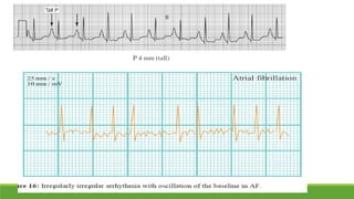 Basic ecg | PPTX