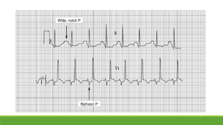 Basic ecg | PPTX