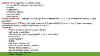 Poor R Wav Progression Basic ecg | PPTX