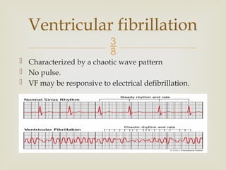 Vf Wave BASIC ECG...........................pptx